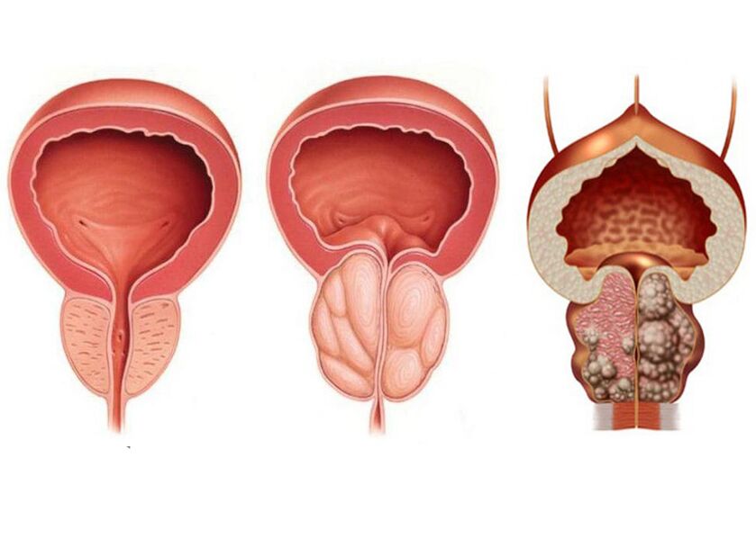 Étapes de la prostatite et la nécessité d'utiliser pleinement la prostavit